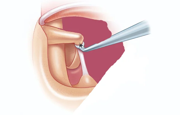 Stapedotomy