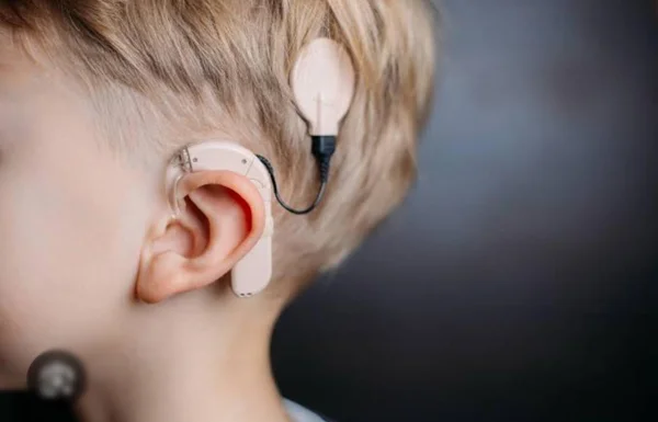 Cochlear Implantation