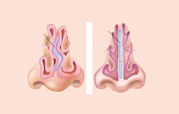 Endoscopic Septoplasty
