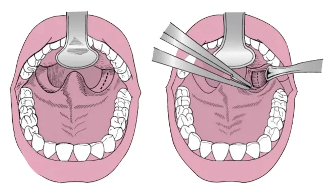 Styloidectomy