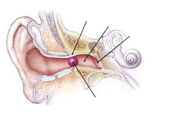 Foreign body removal