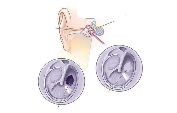 Tympanoplasty Surgery